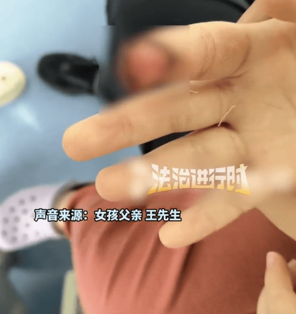 家长称7岁女儿被汗血宝马咬掉手指前端,“一辈子带点残缺”,景区回应:X光显示未伤及骨头,已先行支付10万
